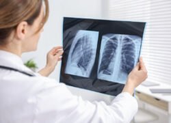 Idiopatinės plaučių fibrozės simptomai, gydytoja vertina plaučių rentgeno nuotrauką