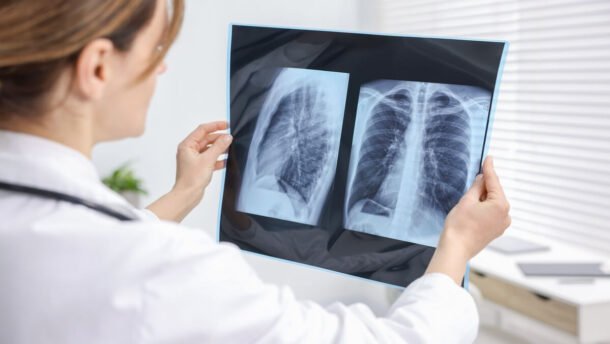 Idiopatinės plaučių fibrozės simptomai, gydytoja vertina plaučių rentgeno nuotrauką