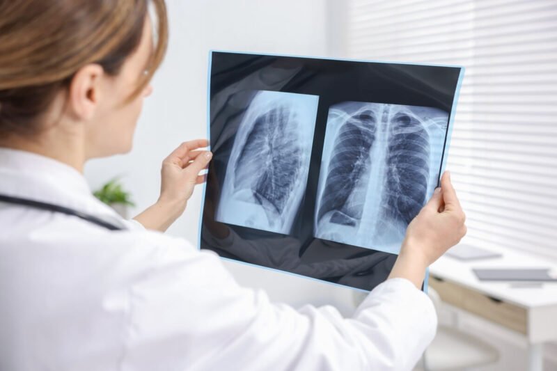 Idiopatinės plaučių fibrozės simptomai, gydytoja vertina plaučių rentgeno nuotrauką