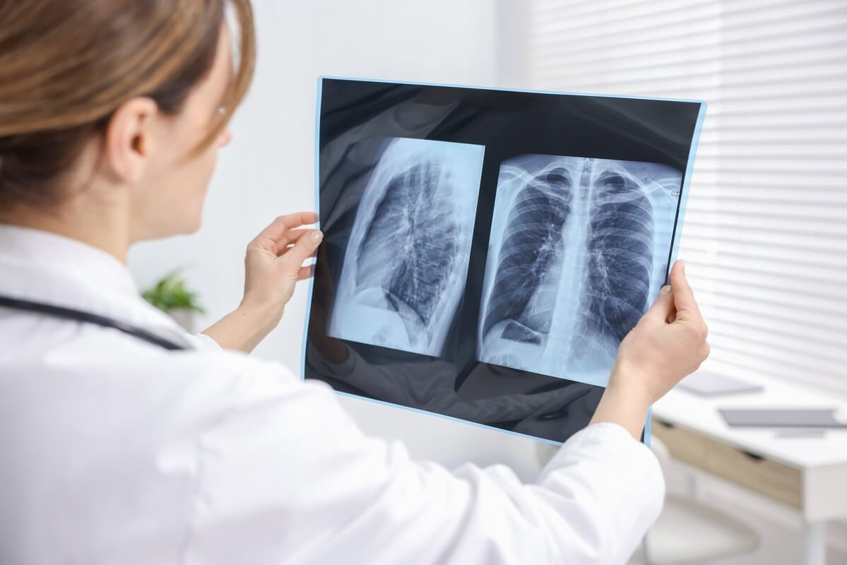 Idiopatinės plaučių fibrozės simptomai, gydytoja vertina plaučių rentgeno nuotrauką
